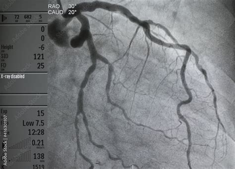 Coronary Angiogram Medical X Ray For Heart Disease Coronary Artery