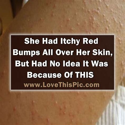 She Had Itchy Red Bumps All Over Her Skin But Was Shocked When She