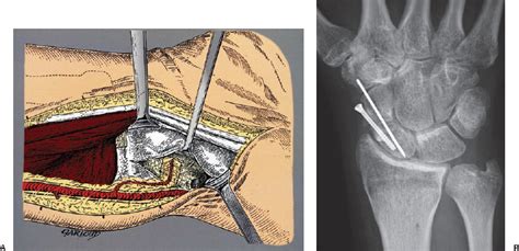 29 The Volar Carpal Artery Vascularized Bone Graft For Scaphoid