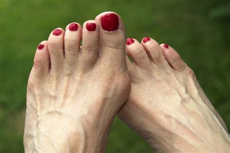 Foot Problems People Mistake For A Bunion