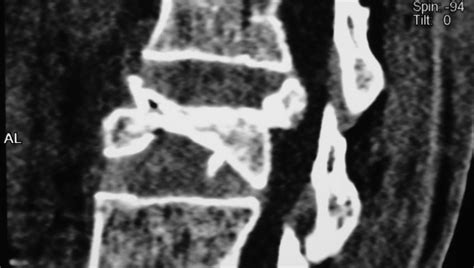 Spine Burst Fracture Of Vertebral Body Radiopaedia