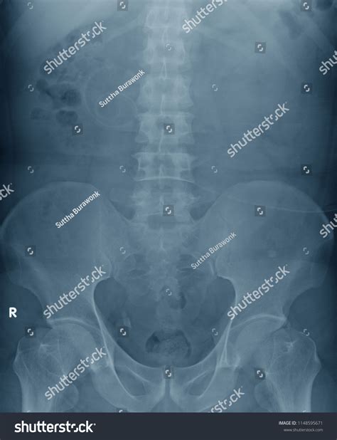 Xray Image Kidney Urinary Bladder Kub Stock Photo 1148595671 Shutterstock