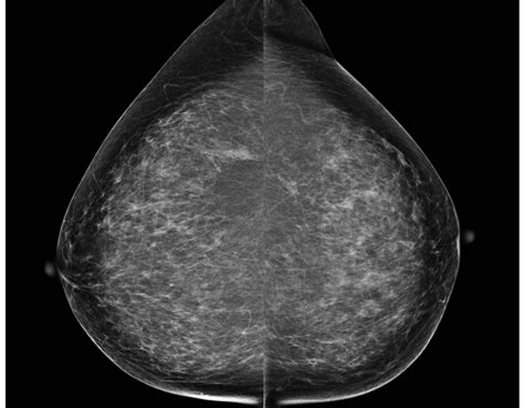 Mammography Vs Thermography Comparing The Benefits Atatun