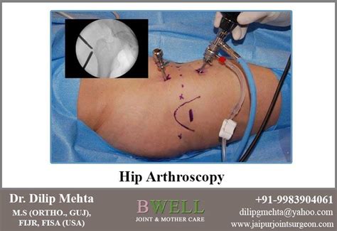 Arthroscopy Is A Surgical Process Which Is Used To Diagnose And Treat A