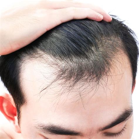 Stress And Hair Loss Cosmedica Clinic Dr Levent Acar