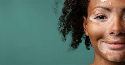 What Is Vitiligo Top 5 Vitiligo Types Causes And How To Manage It
