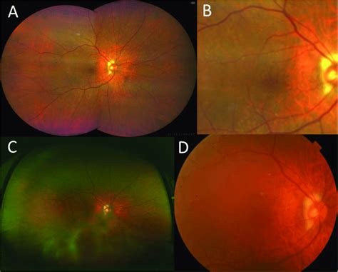 Fundus Photographs Of A Normal Eye Obtained Using The Three Imaging