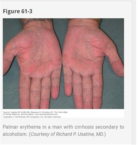 Do Visible Palm Veins Signal Anything British Liver Trust