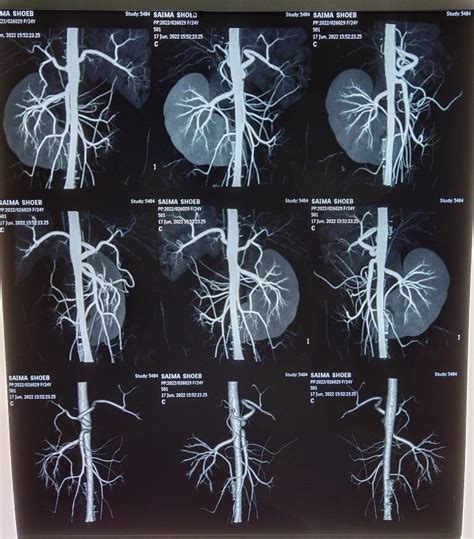 Pin By Radtechinfo On Ct Scan Of Renal Angiography In 2022 Ct Scan