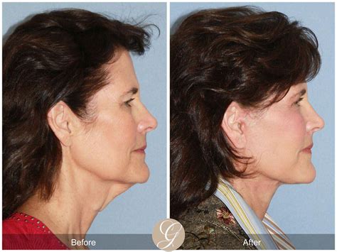 Neck Lift Before And After Photos Patient 04 Dr Kevin Sadati