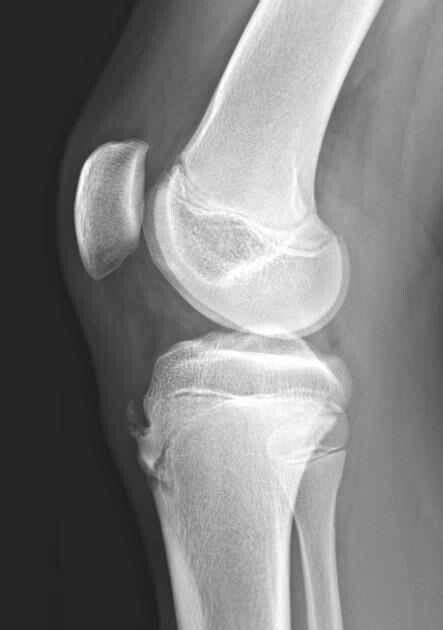 Osgood Schlatter Disease Osd Is A Chronic Fatigue Injury Due To