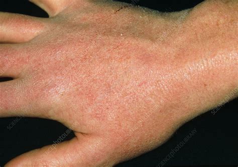 Allergic reaction to food on skin. Dry skin reaction on hand due to anti-acne drug - Stock ...