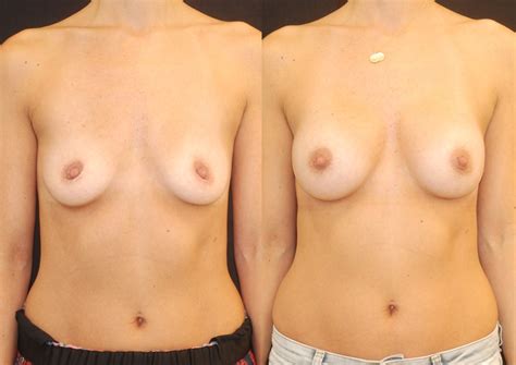 Mini Breast Augmentation Lara Devgan MD MPH FACS