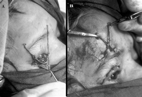 Long Term Results Of Frontalis Suspension Using Autogenous Fascia Lata