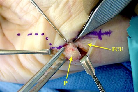 PISIFORM FRACTURES | Hand Surgery Source