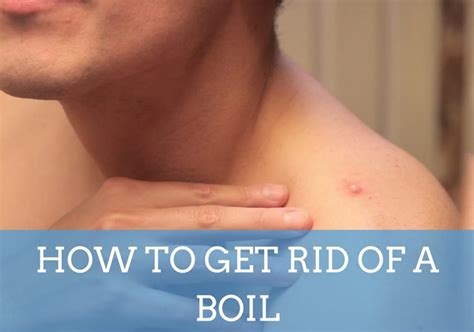 10 Top Home Remedies To Get Rid Of Boils