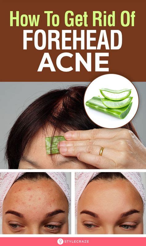 How To Get Rid Of Pimples On Forehead With Images Forehead Acne