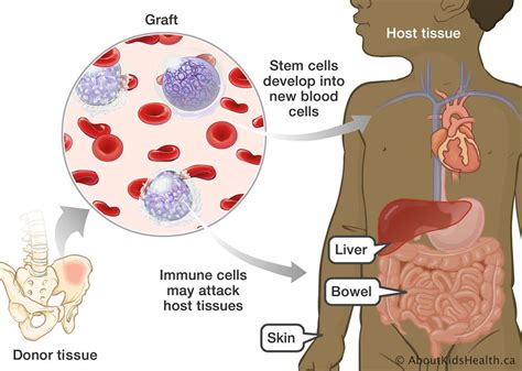 P ec k g l, herzig gp, eli as pm: Graft-versus-host disease after a blood and marrow transplant