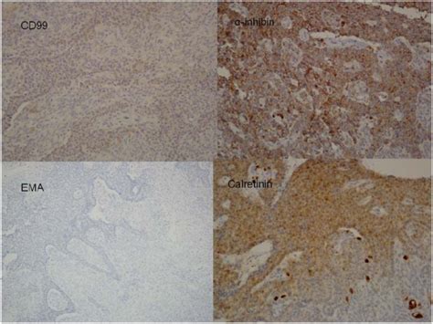 A Late Recurring And Easily Forgotten Tumor Ovarian Granulosa Cell