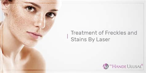 Treatment Of Freckles And Stains By Laser Dr Hande Ulusal