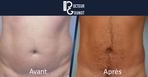 Liposuccion lyon, fièrement propulsé par wordpress. Liposuccion homme à Lyon - Lipoaspiration abdominale ...
