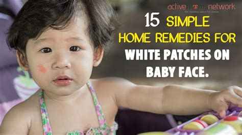 15 Simple Home Remedies For White Patches On Baby Face Youtube