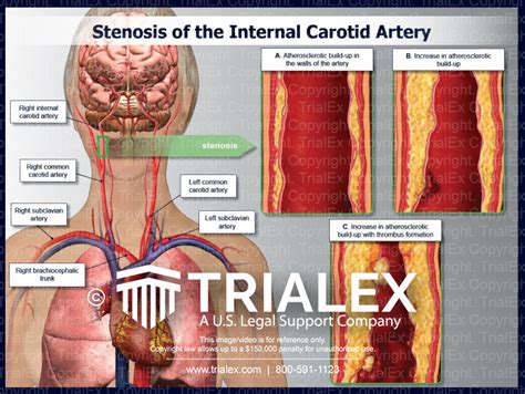 Progression Of Stenosis Internal Carotid Artery Trialexhibits Inc