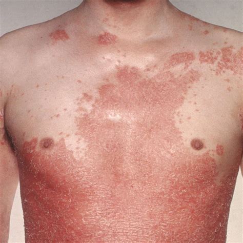 Psoriasis Symptoms Diagnosis Treatment