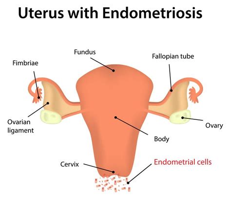 Endometriosis And Ivf Infertility Treatment Options Azarh