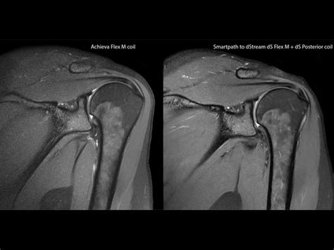 Listen to mffe | soundcloud is an audio platform that lets you listen to what you love and share the sounds you create. Shoulder imaging with dS Flex coil | Philips MR Body Map