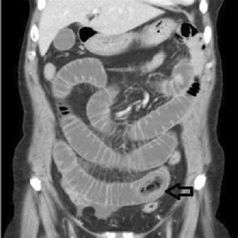 Coronary View Of Abdominal Ct Scan Black Arrow Shows The Foreign Body