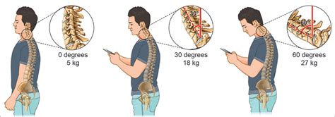 Musculoskeletal Neck Pain In Children And Adolescents Risk Factors And