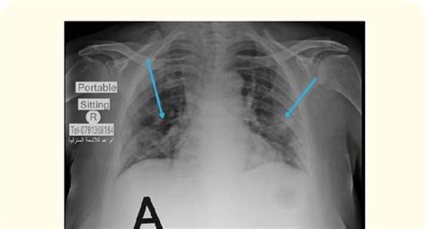 Figure A Portable Home Chest X Ray Of A 65 Year Old Female Showing