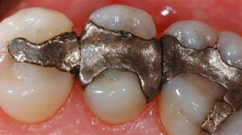 Are Metal Tooth Fillings Dangerous To Health Dental Solutions Of Avon