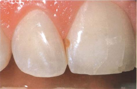 Direct Anterior Restorationsaesthetics And Function Pocket Dentistry