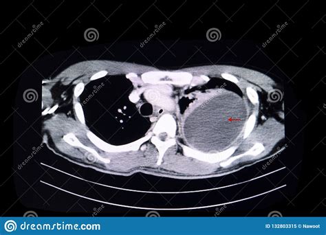 In transudative effusion, specific gravity is below 1.015 and. Loculated pleural effusion stock image. Image of computer - 132803315