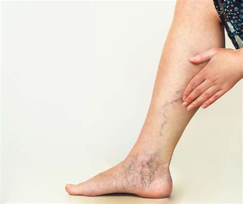 Understanding The Connection Between Varicose Veins And Restless Leg Syndrome And How