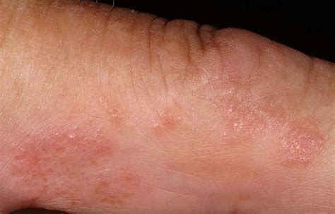 Acute And Recurrent Vesicular Hand Dermatitis Dermatologic Clinics