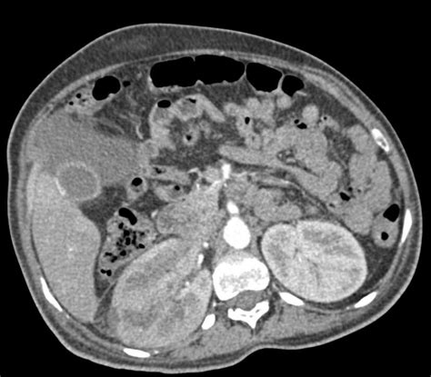 Acute Pyelonephritis Right Kidney Kidney Case Studies Ctisus Ct