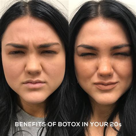 Benefits Of Botox In Your 20s Botox Botox Before And After Spa Day
