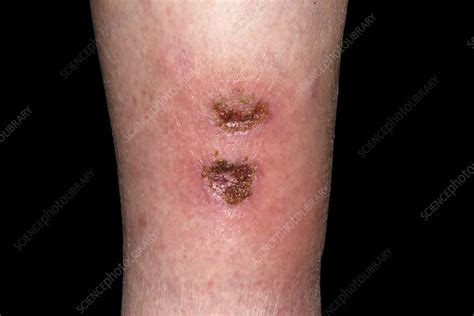 Infected Wounds On Leg Stock Image C0532141 Science Photo Library