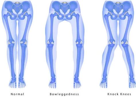 Prolaznik Proizlaziti Hram Za Interakciju Lokomotiva Anemone Ribe Valgus And Varus Knee Mar