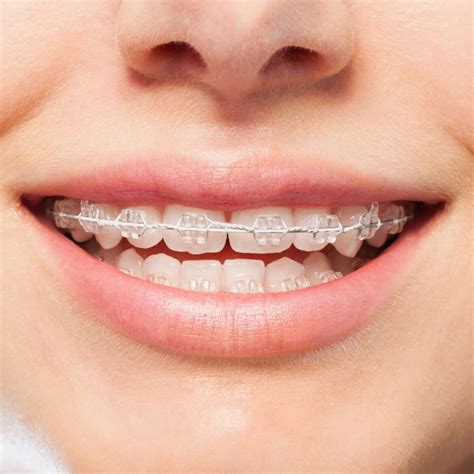 Types Of Braces Drake Orthodontics