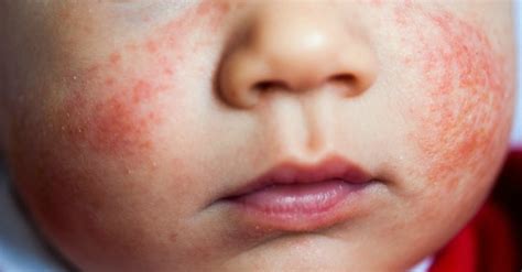 How To Treat Baby Eczema Naturally Easytobemom