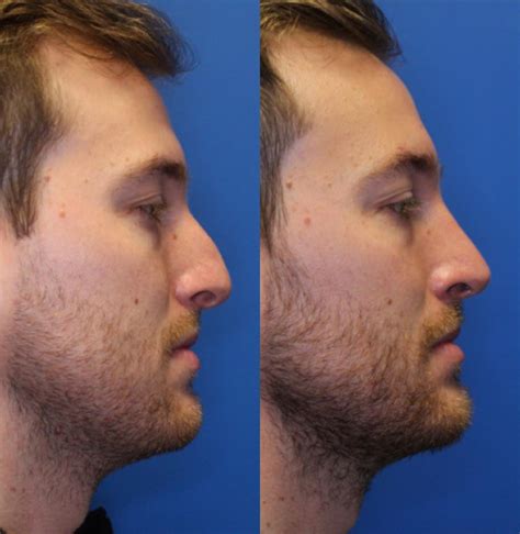 Nose Surgery Before And After Photos Patient 226 San Francisco Ca