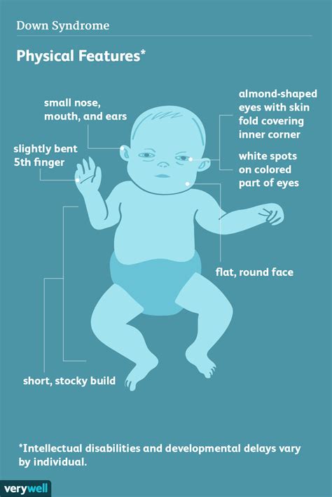 Down Syndrome Signs Symptoms And Characteristics 2022