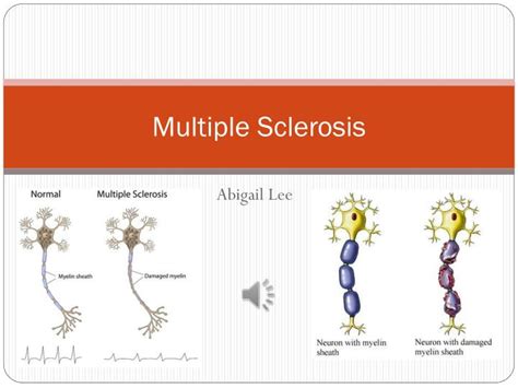 Ppt Multiple Sclerosis Powerpoint Presentation Free Download Id 6320805