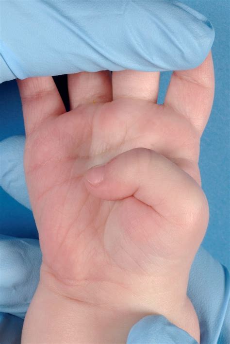 Congenital Clasped Thumb Hand Orthobullets