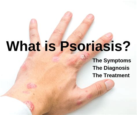 Understanding Psoriasis Symptoms And Treatment With Medication