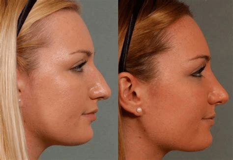 More images for how much is a nose job in south africa » How Much Does A Nose Job Cost In Canada - Job Retro